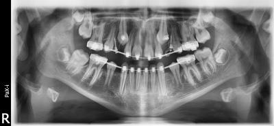 Les canines incluses | Docteur Cinzia Carreri